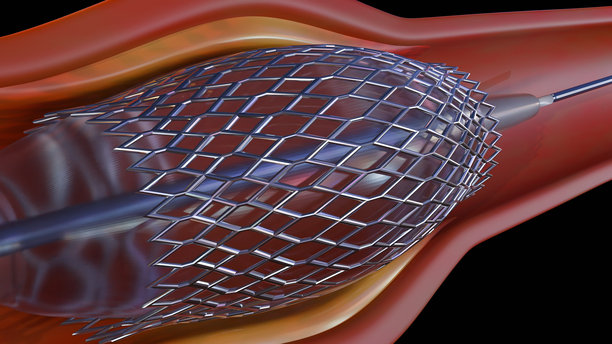 血管内支架的3D效果图图片下载