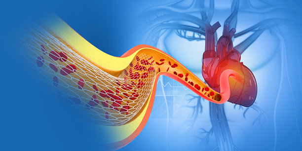 球囊血管成形术支架。三维演示图片下载