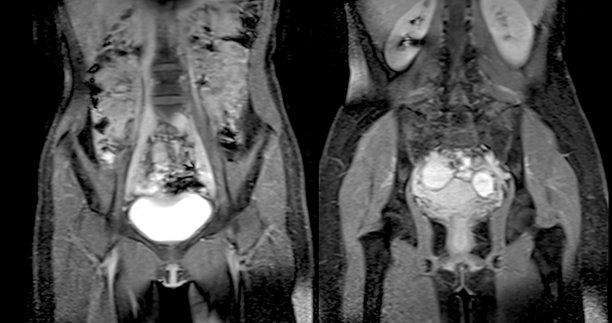 MRI腹部冠状面对精确评估肝脏、肾脏和其他腹部器官特别有用。图片下载