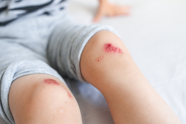 儿童腿部受伤特写。那孩子摔倒时伤了膝盖。干血和抓伤的皮肤。图片下载