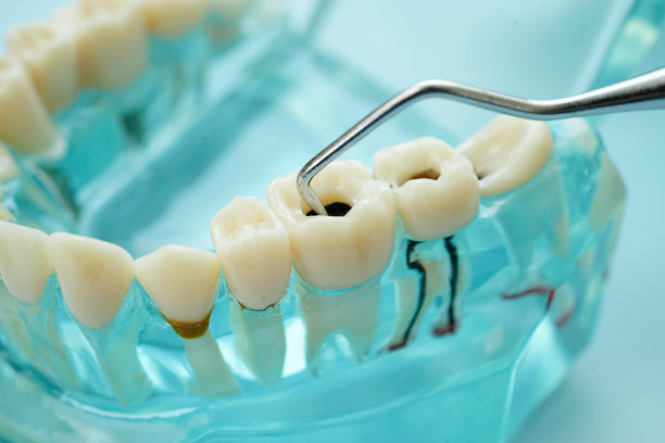 牙齿模型与工具牙医使用的清洁护理治疗。图片下载