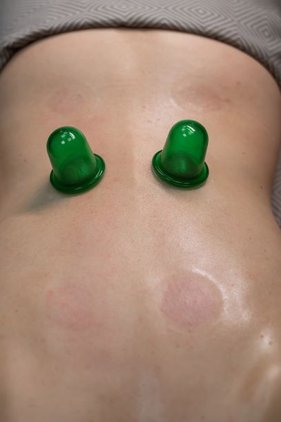 一名妇女正在用真空塑料瓶接受按摩。垂直的照片。图片下载