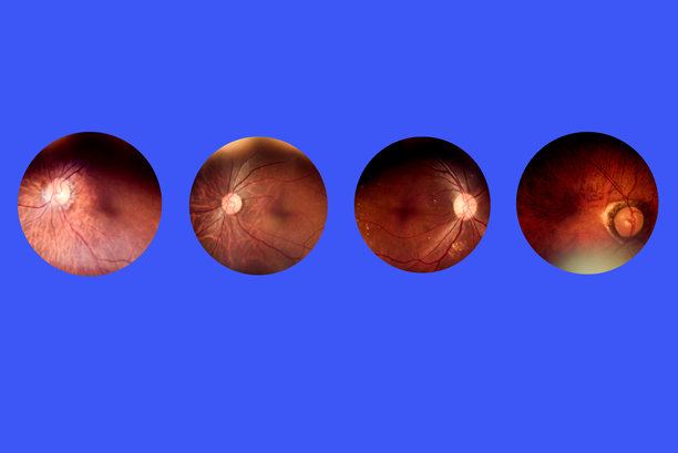 人眼疾病内部视图 - 显示视网膜、视神经和黄斑。视网膜图片，糖尿病牵引性（眼科筛查）视网膜脱落医学照片图片下载