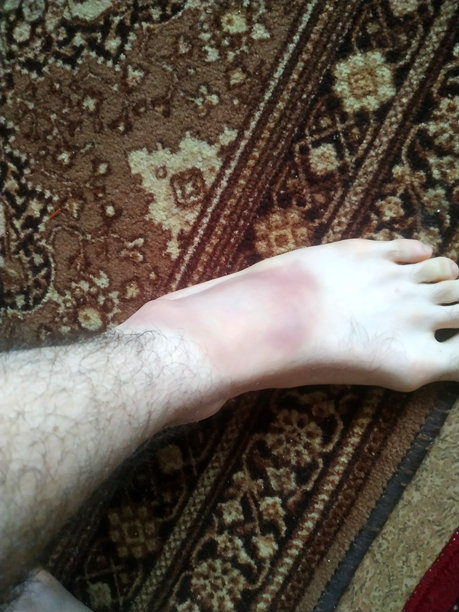 一只脚靠在有图案的地毯上特写，显示出因在家意外受伤而明显的淤伤。图片下载