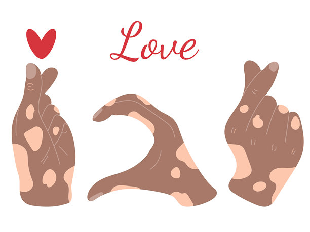 显示手指爱心手势的白癜风皮肤手部，扁平风格矢量插画图片下载