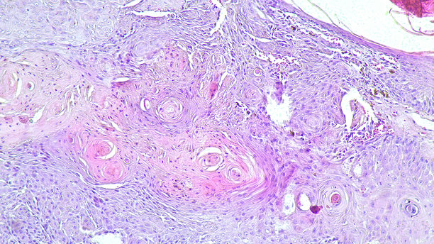 皮肤脂溢性角化病的光镜照片，苏木精-伊红染色，病理实验室的显微镜视图。图片下载