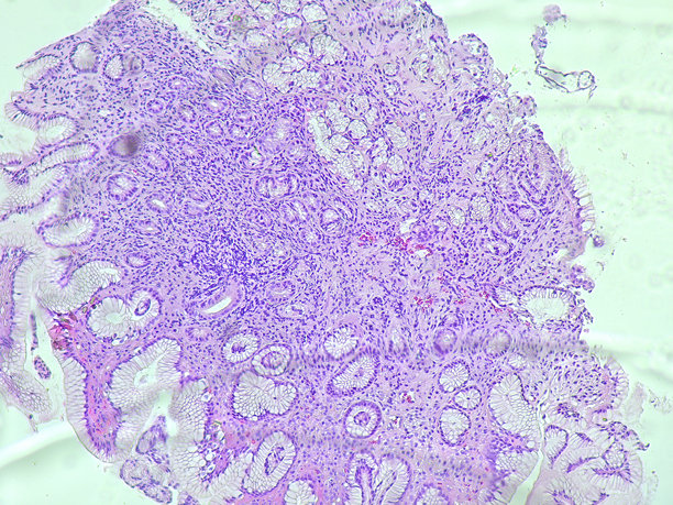 病理实验室显微镜下的人类细胞组织。显示慢性胃病的显微照片，显示幽门螺旋杆菌感染，使用苏木精-伊红染色。图片下载