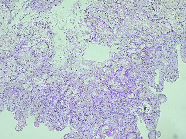 病理实验室显微镜下的人类细胞组织。显示慢性胃病的显微照片，显示幽门螺旋杆菌感染，使用苏木精-伊红染色。图片下载