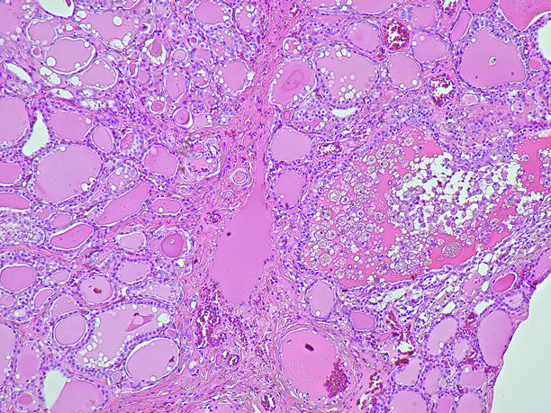 病理解剖实验室中桥本甲状腺炎（慢性淋巴细胞性甲状腺炎）的显微照片图片下载