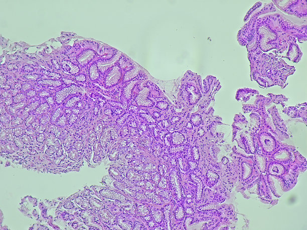 病理实验室显微镜下的人类细胞组织。慢性胃病的显微照片显示幽门螺杆菌感染，使用苏木精-伊红染色。图片下载