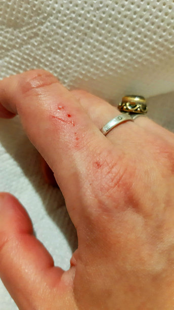 皮肤病，炎症过程，血液。手术，创伤，出血的伤口。疼痛，痛苦，医院。照片颜色图片下载