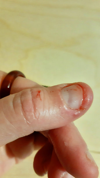 受伤的手指伴有血迹。手术，创伤，出血的伤口。疼痛，痛苦，医院。彩色照片图片下载