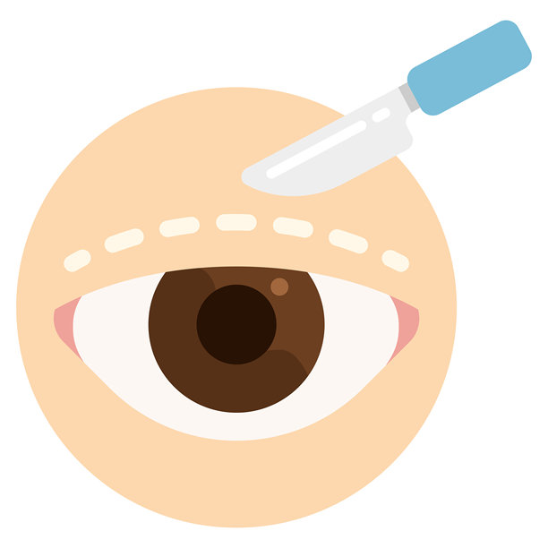 双眼皮手术 眼睑成形术 整形手术图片下载