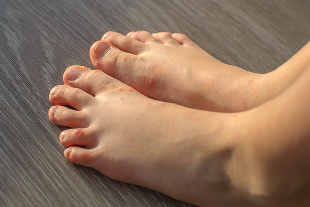 婴儿脚部特写照片，俯视图，覆盖着红色皮疹小丘疹，腺病毒感染或过敏反应，皮肤儿童疾病的概念图片下载