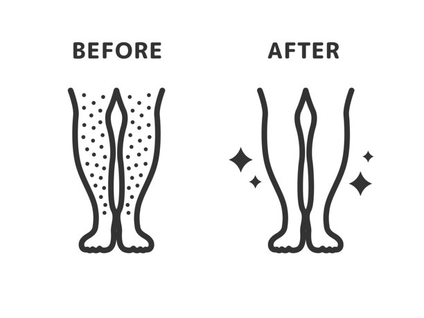 腿部脱毛前后的图标插图（线条画）。图片下载