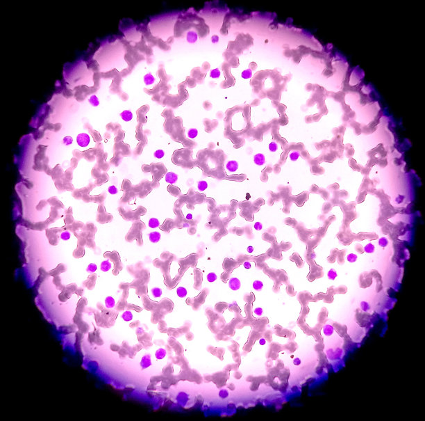 白细胞-红细胞母细胞性贫血伴血小板减少，可能为急性髓系白血病M5b。可见异型细胞和有核红细胞。图片下载