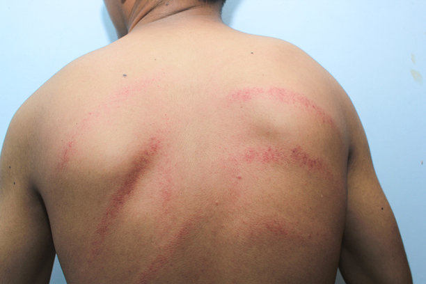 背部刮痧。图片下载