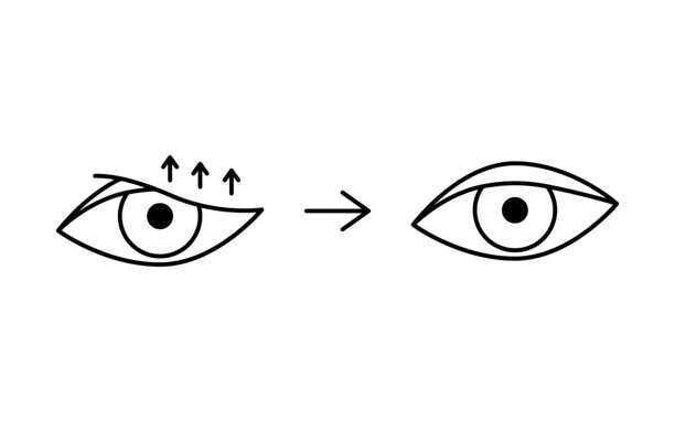 下垂眼睑矫正，眼睑成形术线条图标。眼部美容整形手术。提拉眼睑。外科面部年轻化。矢量图。图片下载