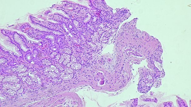 病理实验室显微镜下的人类细胞组织。慢性胃病的显微照片显示幽门螺旋杆菌感染，使用苏木精-伊红染色。图片下载