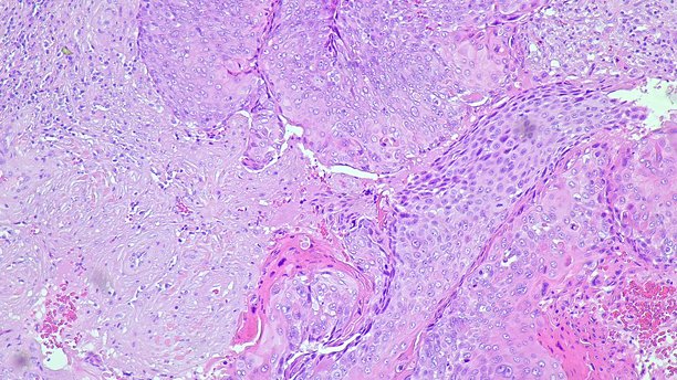 侧结肠非角化鳞状细胞癌的显微照片，拍摄于解剖病理实验室显微镜下图片下载