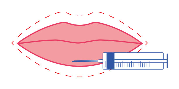 注射唇部和面部的图标。红唇接受注射的插图。唇部增大过程。美容学，医学。EPS 10。矢量插图图片下载