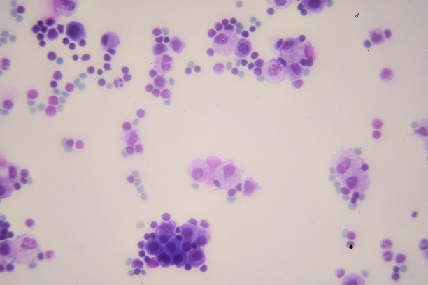 胸腔积液显示由B细胞淋巴瘤引起的乳糜胸图片下载