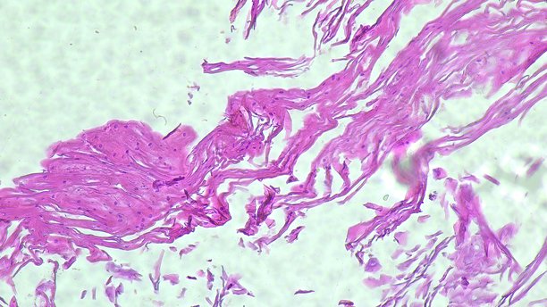 显示右侧股骨动脉粥样硬化囊肿组织学的显微照片，拍摄于解剖病理实验室图片下载