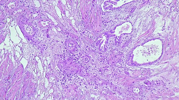 显微照片显示解剖病理实验室中良性前列腺增生的组织学特征图片下载