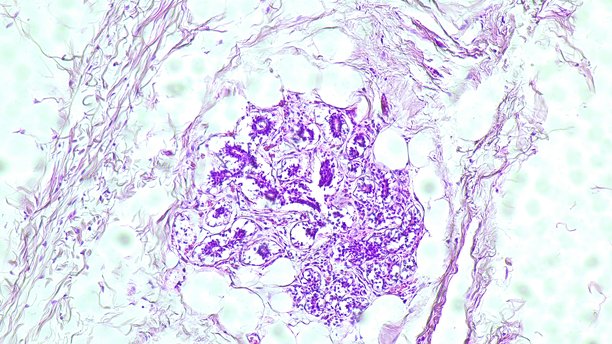 乳腺侵袭性癌症的显微照片。恶性细胞，人类乳腺癌的腺癌，病理实验室中的H和E染色组织切片。图片下载