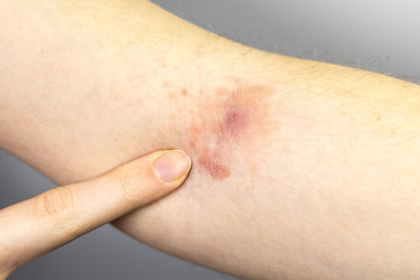 女性手部显示脓性脓肿伴有刺激和皮炎。葡萄球菌炎症。特写，医学照片。图片下载