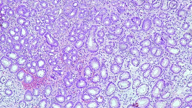 病理实验室中显微镜下的人类细胞组织。显示慢性胃病的显微照片，显示幽门螺杆菌感染，使用苏木精-伊红染色。图片下载