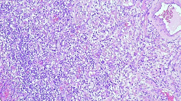 显微照片显示解剖病理实验室中良性前列腺增生的组织学特征图片下载