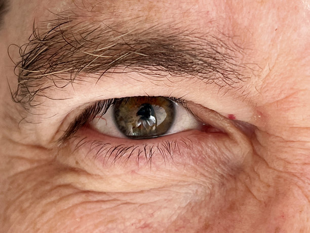 一张特写照片显示一名男子的绿色和榛色眼睛，明显的红肿和刺激与结膜炎一致。图片下载