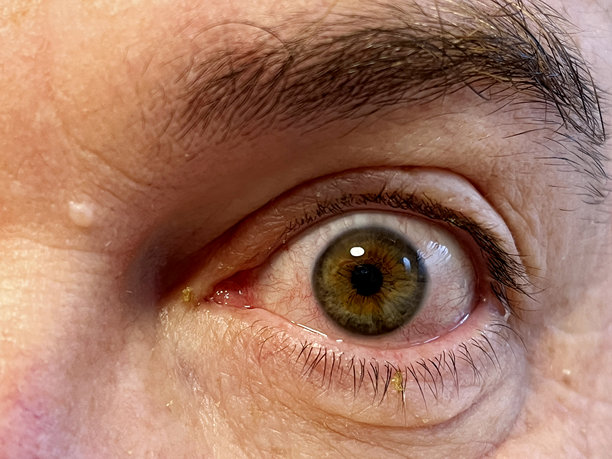 一张特写照片显示一名男子的绿色和榛色眼睛，明显的红肿和刺激与结膜炎一致。图片下载