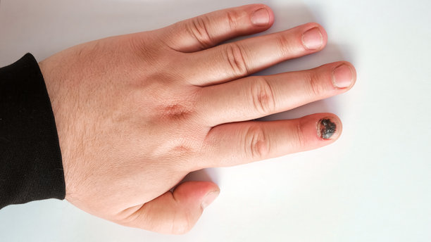 受伤的拇指指甲淤血，甲下血肿，孤立在白色背景上。疼痛的淤伤，意外，受伤的手指和医学概念。特写俯视图。难看的疼痛。高质量照片。图片下载