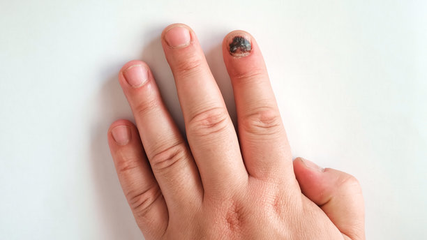 受伤的拇指指甲淤血，甲下血肿，孤立在白色背景上。疼痛的淤伤，意外，受伤的手指和医学概念。特写俯视图。难看的疼痛。高质量照片。图片下载