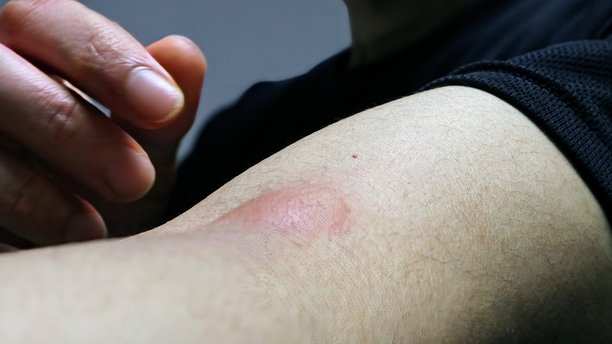 手臂上有蚊子叮咬的人的照片图片下载