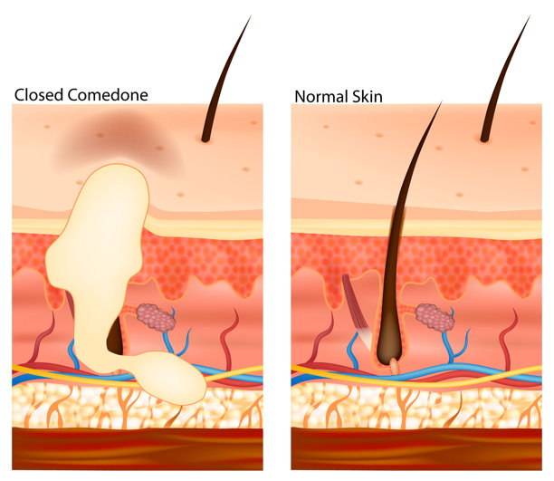 闭合性粉刺与正常皮肤的医学插图。该图展示了皮肤层、毛囊、皮脂腺以及毛孔堵塞的差异。图片下载