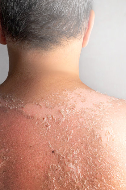 晒伤的皮肤。烧伤后的皮肤。因过敏、脱皮或湿疹而出现的干燥皮肤。需要治疗和滋润的干燥皮肤。特写的垂直纹理照片。图片下载