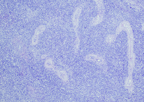 弥漫性大B细胞淋巴瘤生发中心B细胞型图片下载