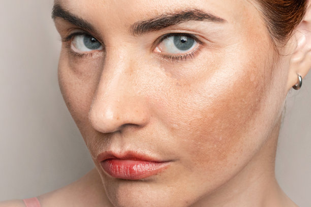 特写照片，展示女性面部的色素沉着、黄褐斑、雀斑和老年斑。图片下载