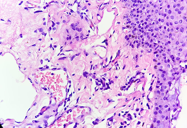 结膜翼状胬肉的显微照片，显示与紫外线（UV）光照射相关的明显退行性变化和太阳弹性变性。图片下载