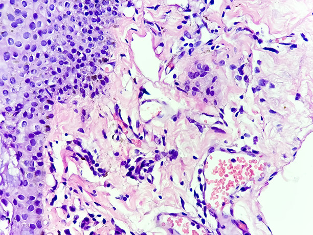 结膜翼状胬肉的显微照片，显示与紫外线（UV）光照射相关的明显退行性变化和太阳弹性变性。图片下载