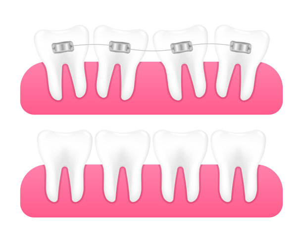 牙齿矫正器。通过牙套系统矫正牙齿排列和咬合。牙齿矫正器。牙科护理概念。矢量插画。图片下载