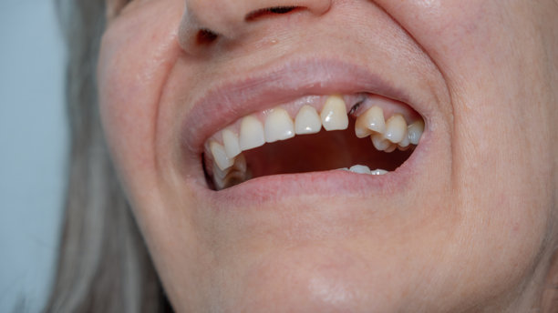 缺失的牙科植入物。一位中年女性张开嘴的特写，显示出从植入物上断裂的缺失牙冠。可见金属残留物。关于植入物可靠性和持久性的概念插图。实拍照片。图片下载