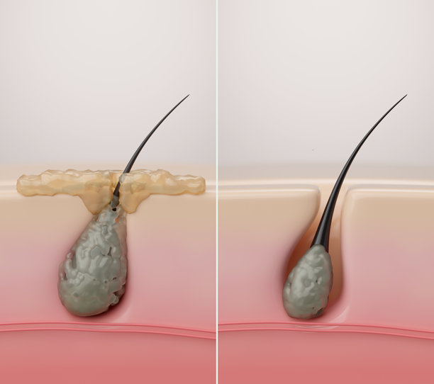 深层毛孔和毛囊清洁的前后对比，3D插画图片下载