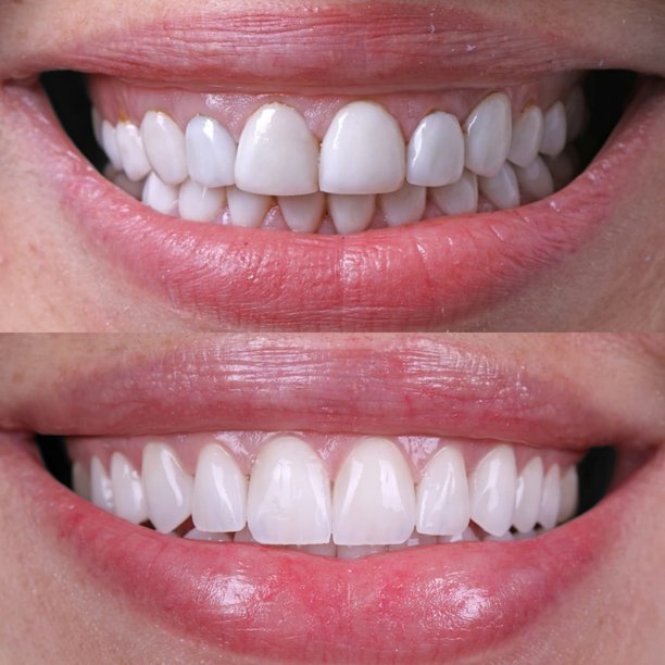 牙齿美白前后对比，展示女性笑容的转变，牙齿洁白亮丽——牙科美容和笑容改造的概念图片下载