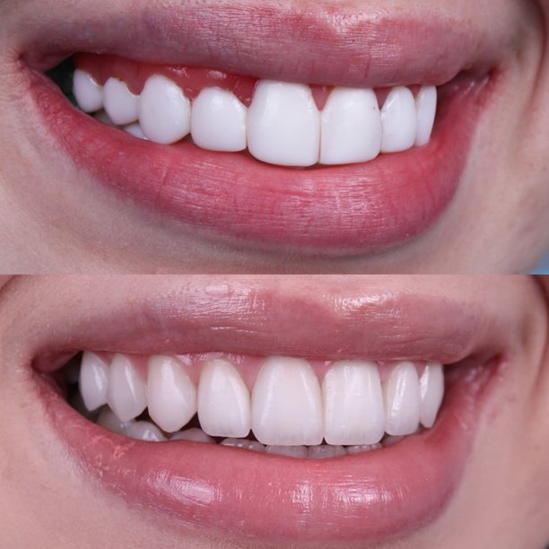 牙齿美白前后对比，展示女性笑容的转变，牙齿洁白亮丽——牙科美容和笑容改造概念图片下载