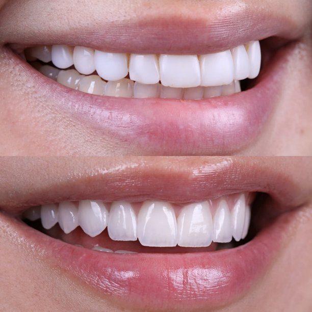 牙齿美白前后对比，展示女性笑容的转变，牙齿洁白亮丽——美容牙科和笑容重塑的概念图片下载