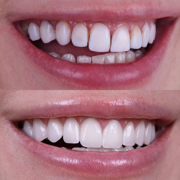 牙齿美白前后对比，展示女性笑容的转变，牙齿变得洁白亮丽——牙科美容和笑容改造的概念图片下载